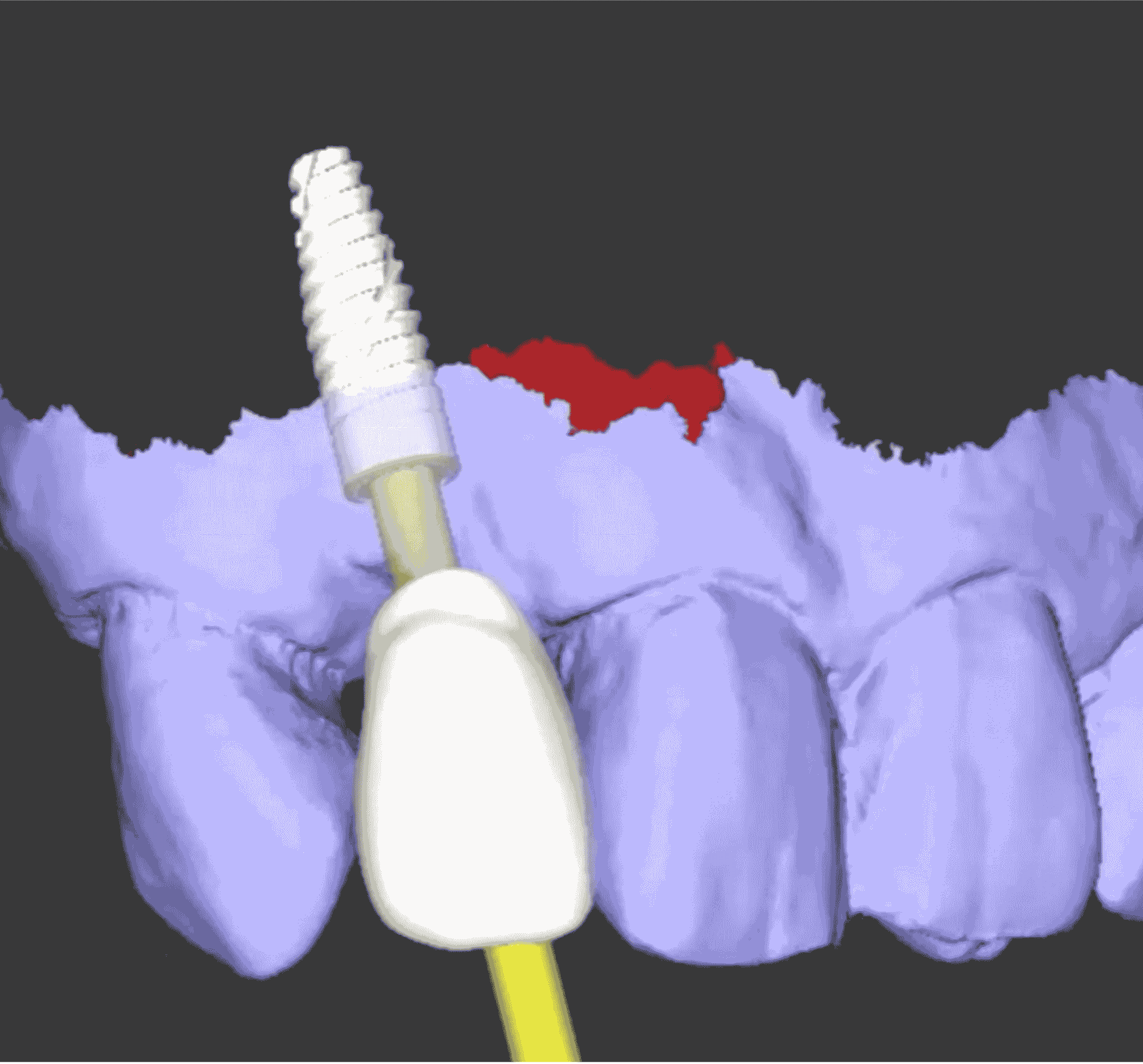 dental implant imaging scan